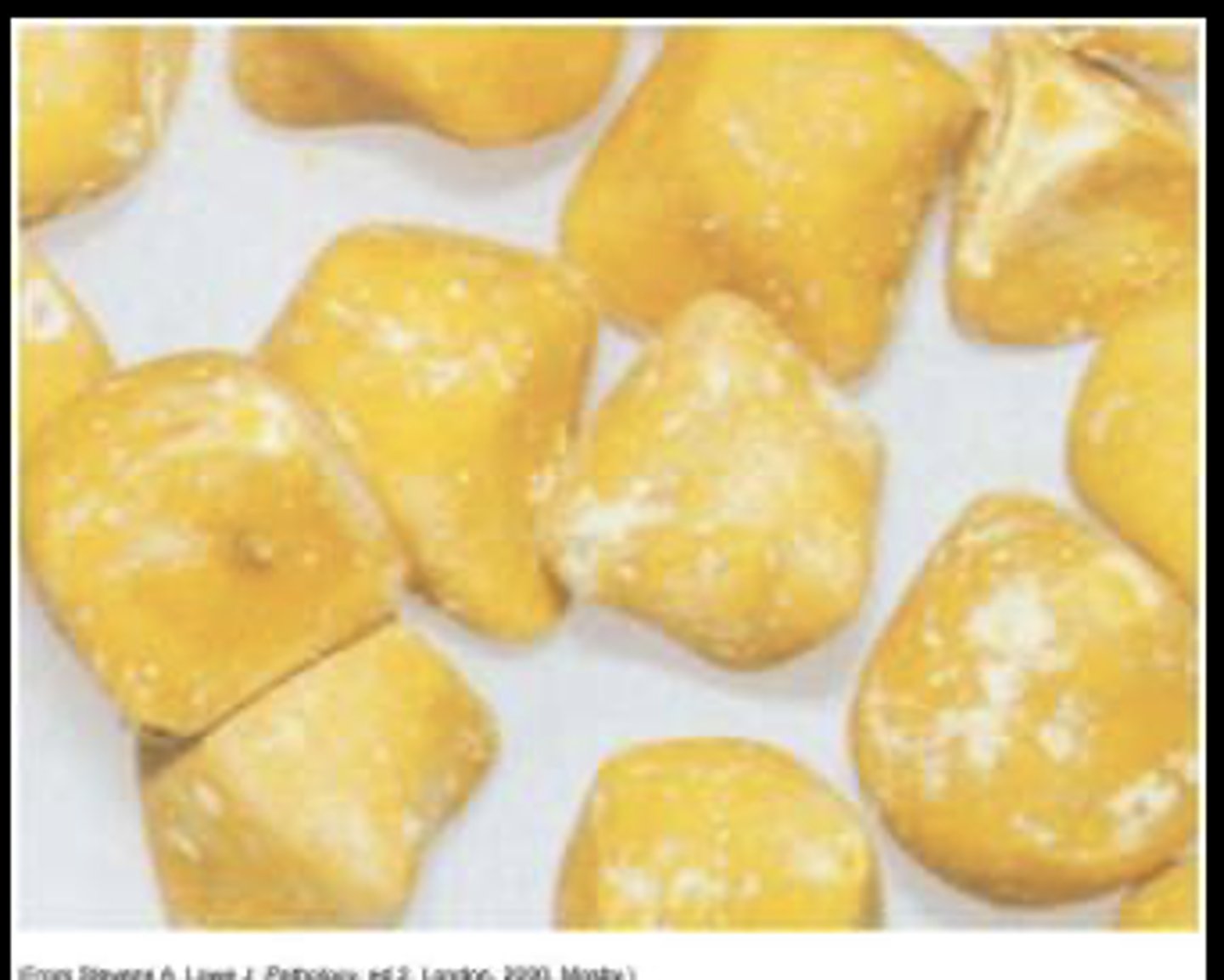 <p>Obstruction or inflammation (cholecystitis) is the most common cause of gallbladder problems</p><p>Cholelithiasis—gallstone formation</p><p>Types</p><p>-- Cholesterol (most common) and pigmented (consequence of cirrhosis)</p><p>Risks</p><p>-- Obesity, middle age, female, Native American ancestry, and gallbladder, pancreatic, or ileal disease</p>