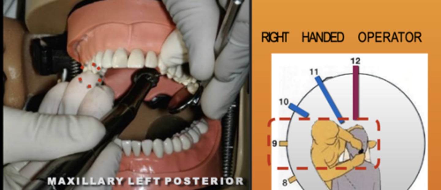 <p>Zone: 9</p><p>Vision: Direct</p><p>Patient's Head: Left</p><p>Fulcrum: Max Right Premolars (O)</p>