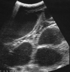 <p>presence of distended loops of intestine on rectal exam and ultrasound</p>