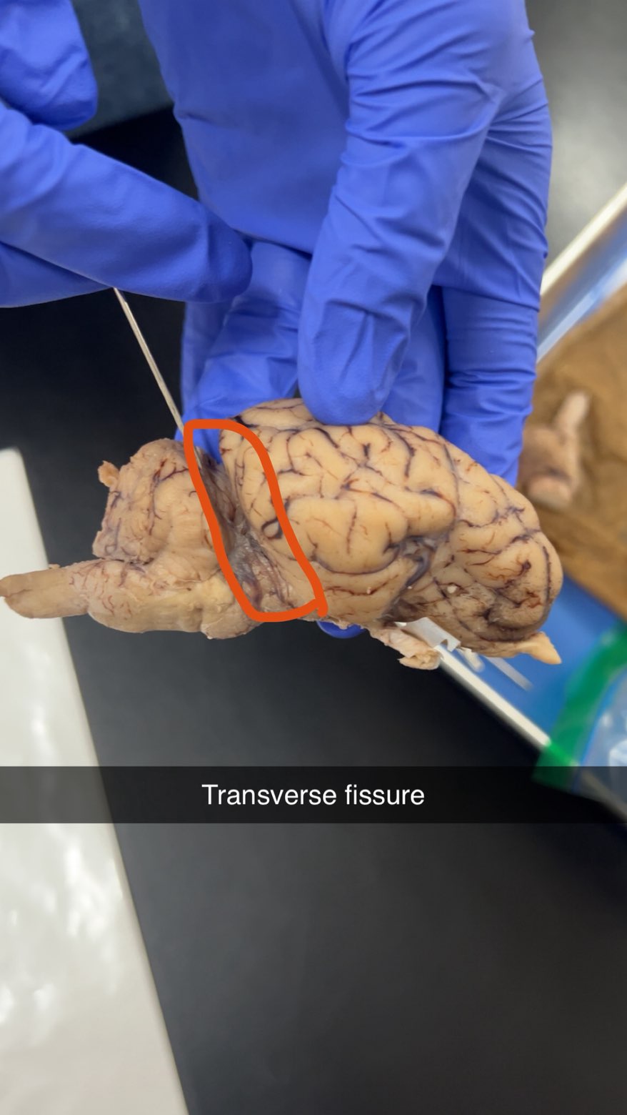 <p>transverse fissure</p>