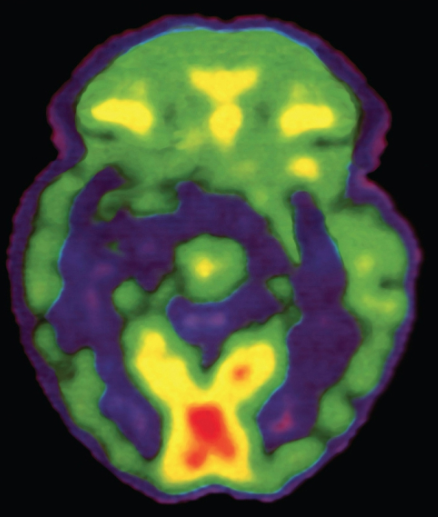 <p>Positron emission tomography (PET) scan</p>