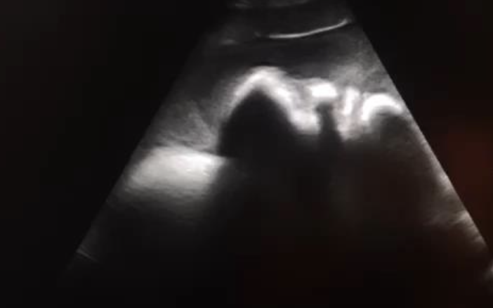 <p>ultrasound: swirling echogenic fluid</p><p>abdominocentesis: hemorrhagic (PCV >18%, TP >3.2)</p>