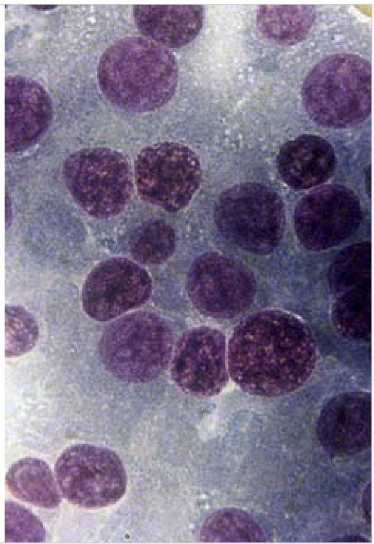 <ul><li><p>Endocrine tumors </p></li></ul><p></p>