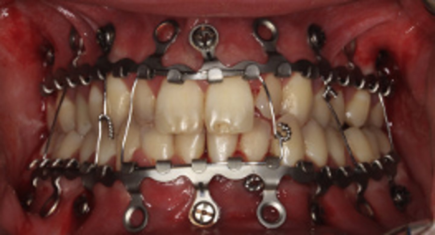 <p>ID the closed treatment/ maxillomandibular fixation:</p><p>•Less time consuming, less skin puncture risk to provider</p><p>•Fixates arch bars directly to the bone with screws</p><p>•Possible damage to tooth roots</p>