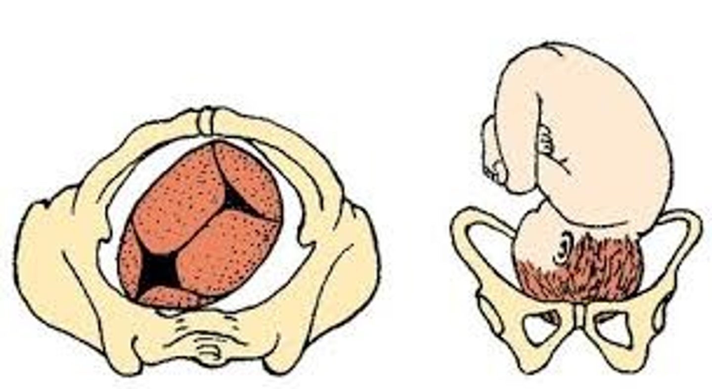 <p>-the best position</p><p>-back of the baby's head faces the front of the mother's pelvis.</p><p>-position is associated with the easiest vaginal deliveries</p>
