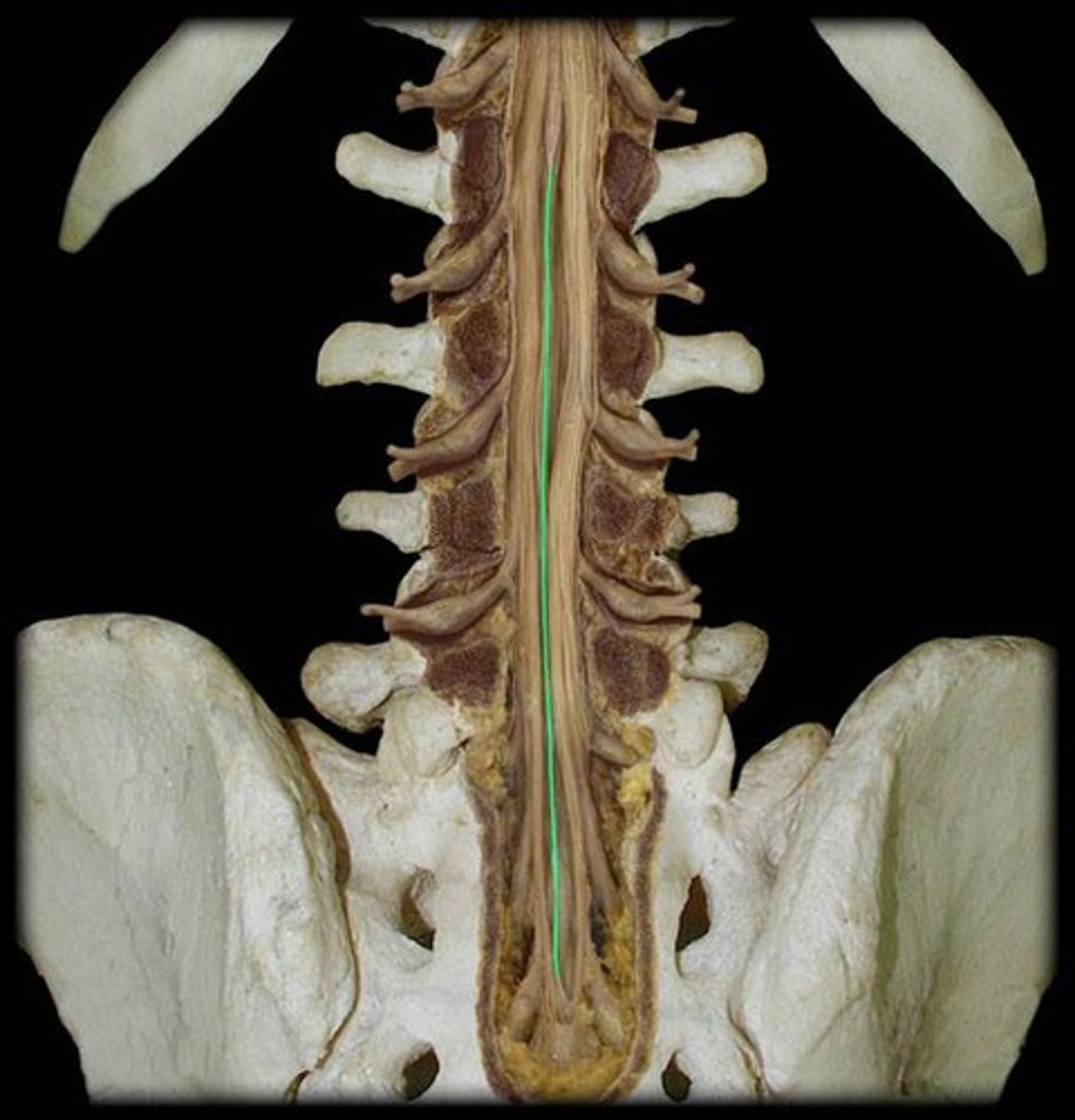 <p>fibrous extension of the pia mater; anchors the spinal cord to the coccyx</p>