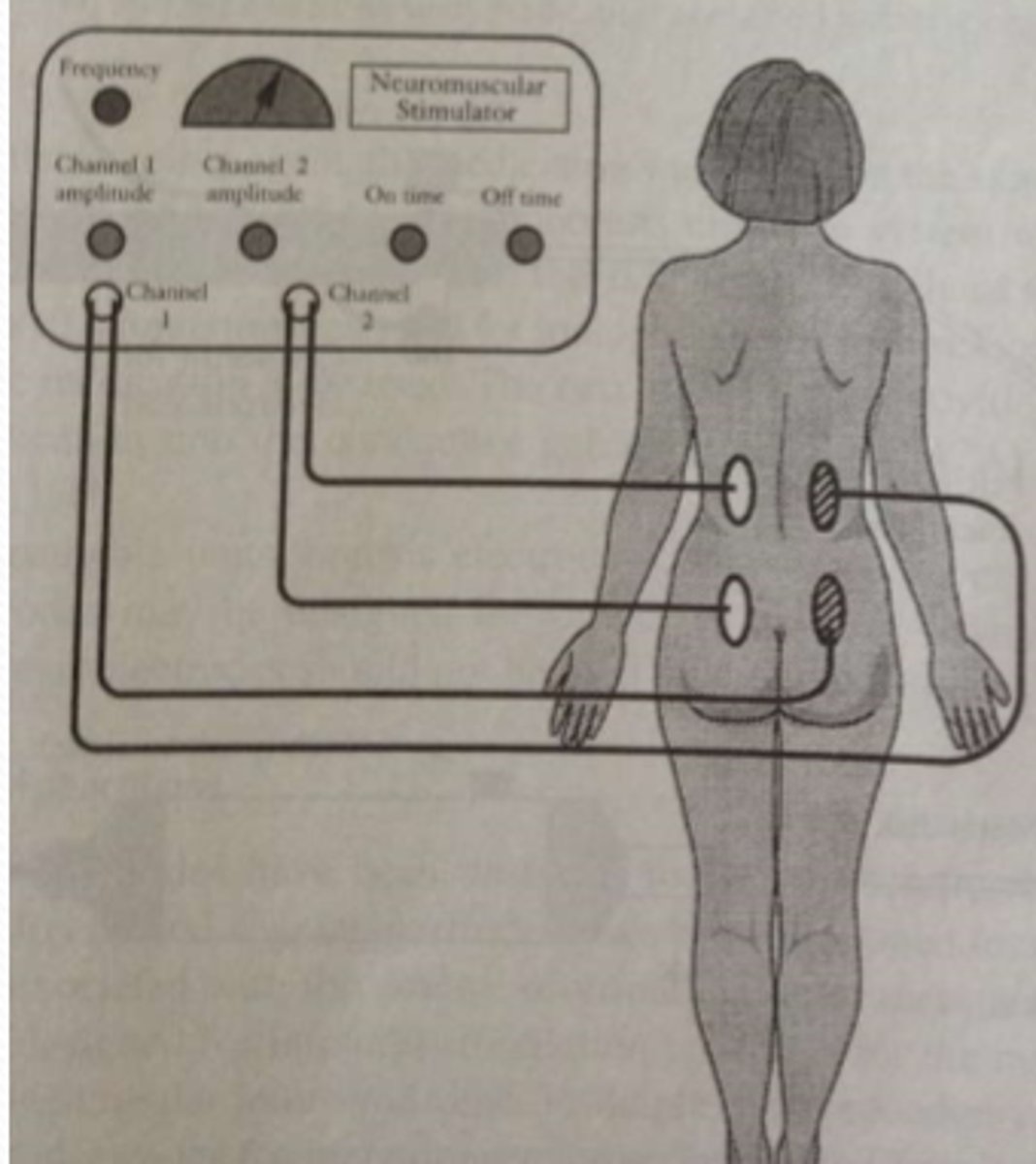 <p>What type of electrical stimulation is depicted?</p>