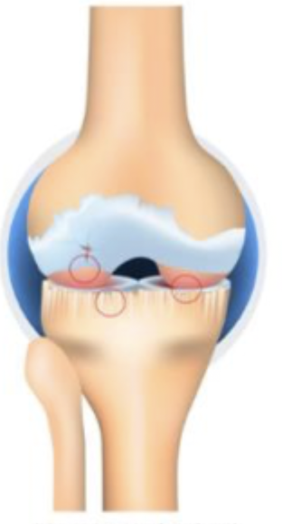 <p>Which stage of OA is characterized by large osteophytes, marked JSN, severe sclerosis, and definite bone end deformity</p>