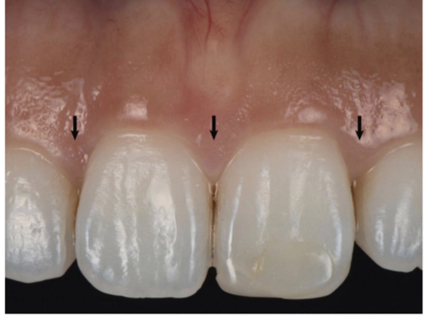 <p>The interdental gingiva (between teeth) occupies the gingival embrasure, which is the interproximal space beneath the area of tooth contact. The interdental gingiva can be pyramidal, or it can have a "col" shape. The shape of the gingiva in a given interdental space depends on the presence or absence of a contact point between the adjacent teeth, the distance between the contact point and the osseous crest Serves to protect underlying osseous structure</p>