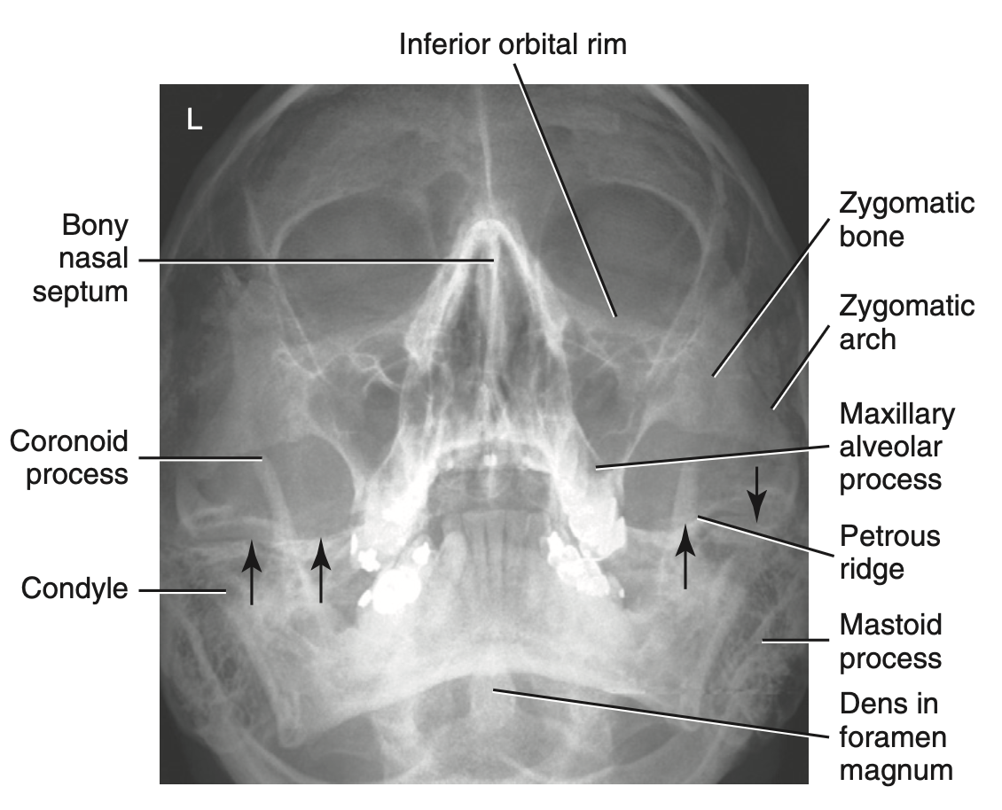 <p>How do you <u>critique</u> radiograph of <strong>Parietocanthial Projection: Waters method </strong>for <strong>facial bone</strong>?</p>