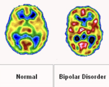 <ul><li><p>reduced hippocampal volume</p></li><li><p>elevated basal ganglia activity (manic phase)</p></li><li><p>increased amygdala volume and activation</p></li><li><p>overall increased activity in brain</p></li></ul><p></p>