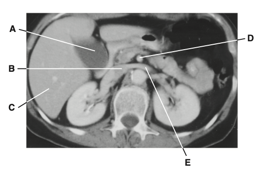 <p>63. Which structure receives blood from the left</p><p class="p1">gonad and suprarenal gland?</p>