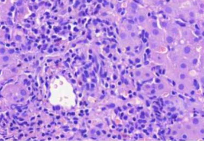 <p>M<strong><u>IKÄ TAUTI?</u></strong> tulehdussoluinfiltraation vuoksi laajentunut portaalialue, portaalialueen reuna on epätarkkarajainen, koska tulehdussolut työntyvät hepatosyyttien väliin maksalobuluksen puolelle, tästä voidaan päätellä, että tulehdus on aktiivinen</p>