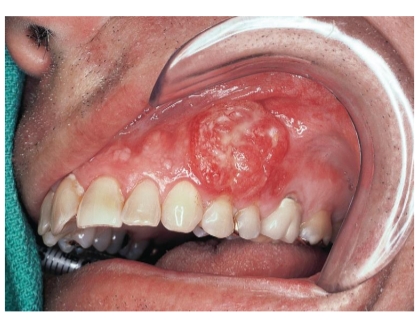 <p>Minder snel regionale metastasering<br>Soms ook carcinoom van accessoire <br>speekselklier<br>Ingroei in maxilla<br>Partiële maxillectomie</p>