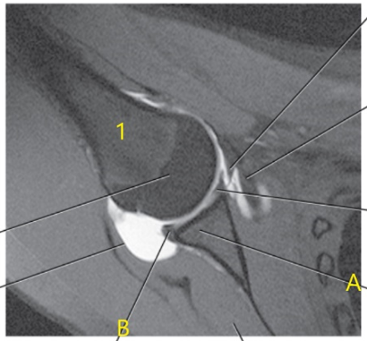 <p>What is this special view of the shoulder joint called ?</p>
