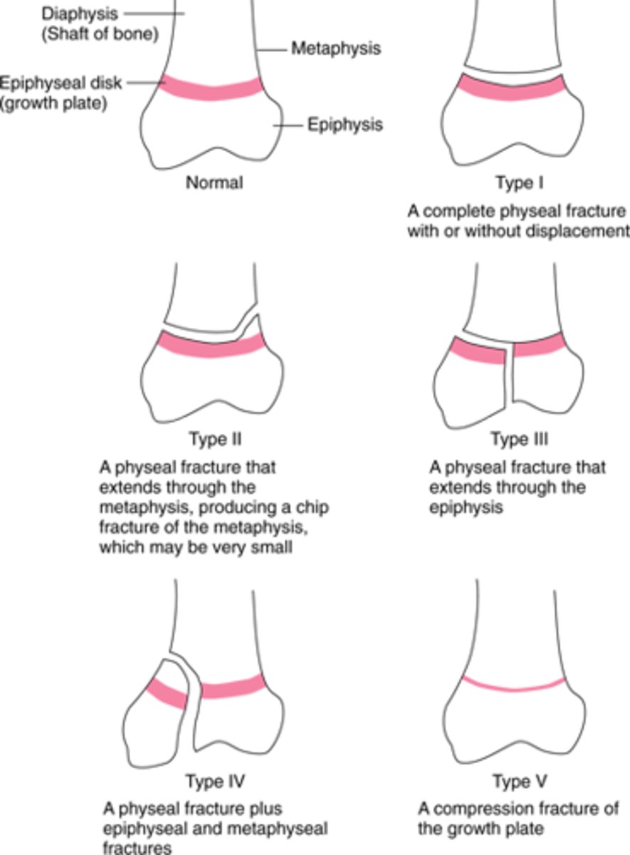 <p>SALTER:</p><p>-Straight across</p><p>-Above (metaphysis)</p><p>-Low or below (epiphyses)</p><p>-Two and through (both)</p><p>-Erasure of growth plate</p><p>-Ruh roh ruined</p>