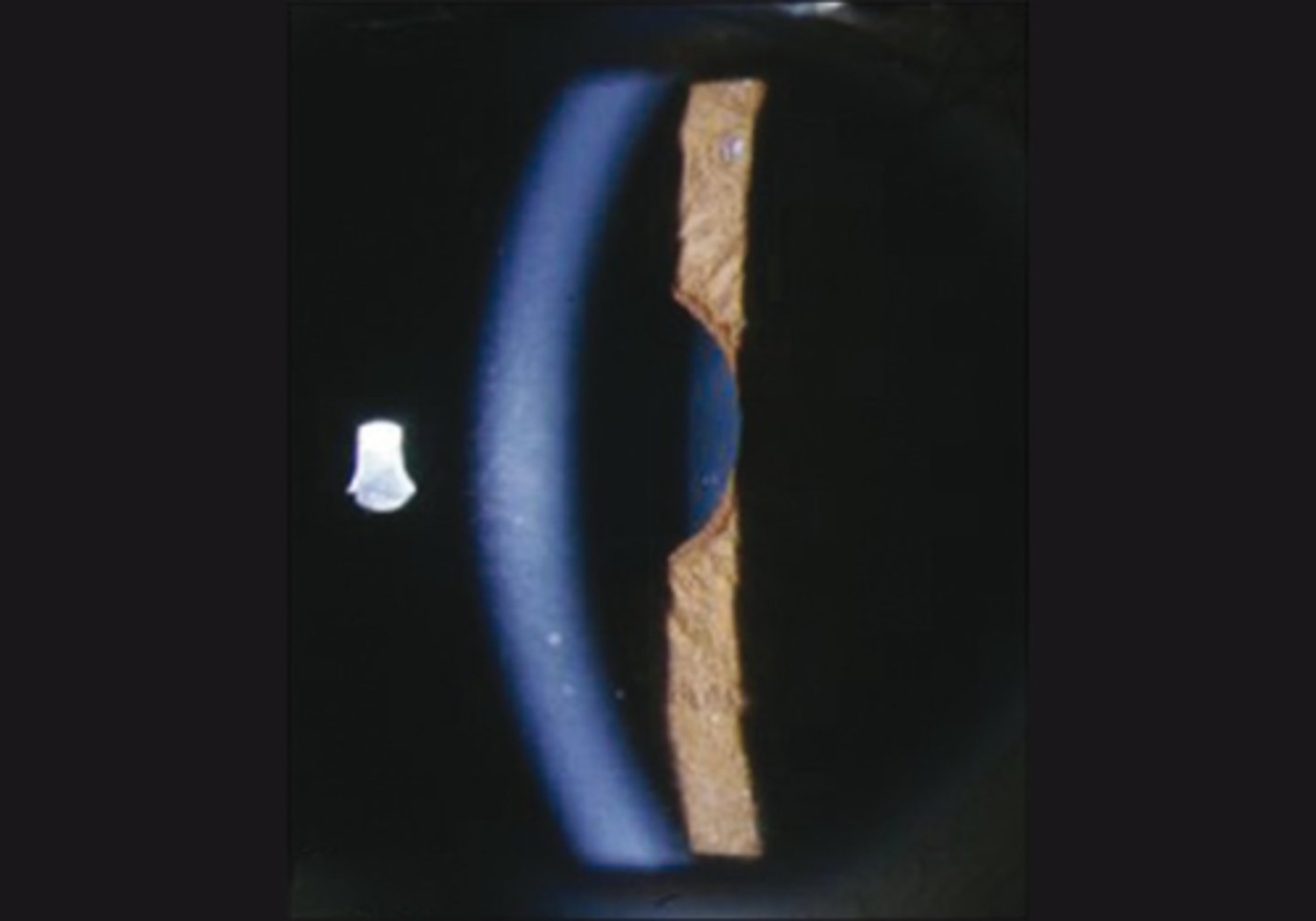 <p>sector paralysis = abnormal shape due to sphincter/dilater paralysis</p><p>stromal spread = iris stroma spreads due to lack of innervation</p><p>pigment stream entropion = pupil border of iris is entropic adjacent to a part of the pupil border that is more flat</p><p>stromal streaming = stroma flows towards area that sphincter still works when light is turned on</p>