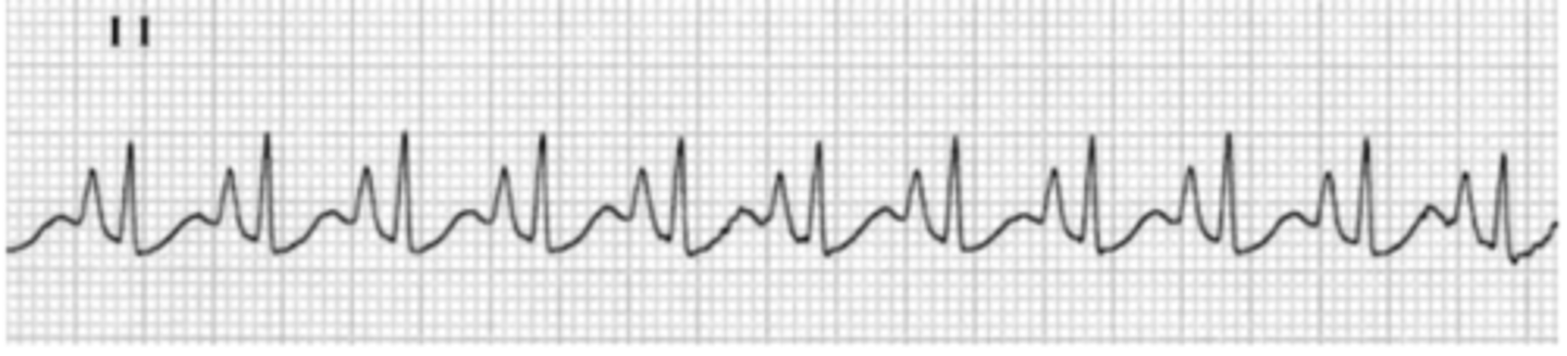 <p>by looking at the P wave, what do we think is wrong with this heart?</p>