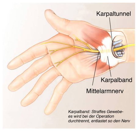 <ul><li><p>Från <strong>plexus brachialis</strong> (C5–T1)</p></li><li><p>Drabbas av <strong>karpaltunnelsyndrom</strong>.</p></li></ul><p></p>