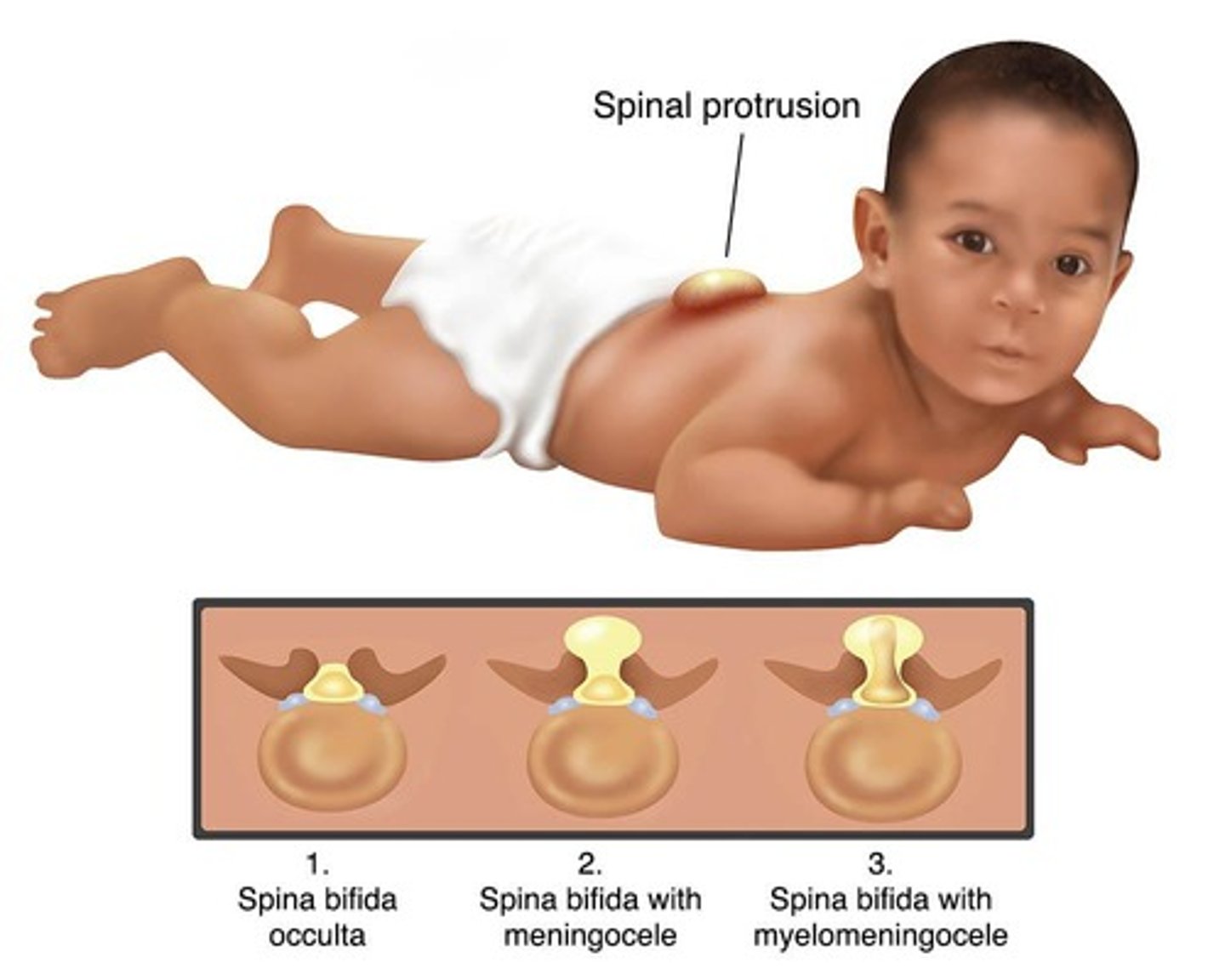 <p>High levels of AFP are seen in open spine defects and multiple fetuses.</p>