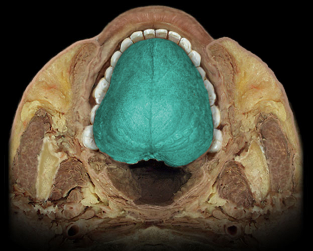 <h4 collapsed="false" seolevelmigrated="true"><strong>Location:</strong></h4><ul><li><p>Superior surface of tongue</p></li></ul><h4 collapsed="false" seolevelmigrated="true"><strong>Description:</strong></h4><ul><li><p>Mucous membrane contains taste buds</p></li><li><p>Dense concentration of papillae gives dorsal surface "felt-like" appearance</p></li><li><p>Divided by V-shaped sulcus terminalis into anterior (oral) part and posterior (pharyngeal)</p></li><li><p>Anterior part has median furrow</p></li><li><p>Posterior part is nodular due to presence of lingual tonsils</p></li></ul>