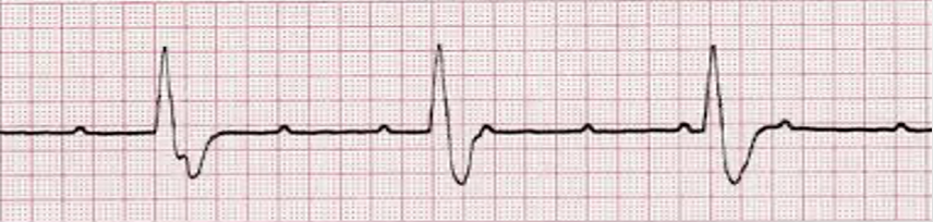 <p>regular R-R unrelated to regular P-P; P &amp; QRS don’t line up</p>