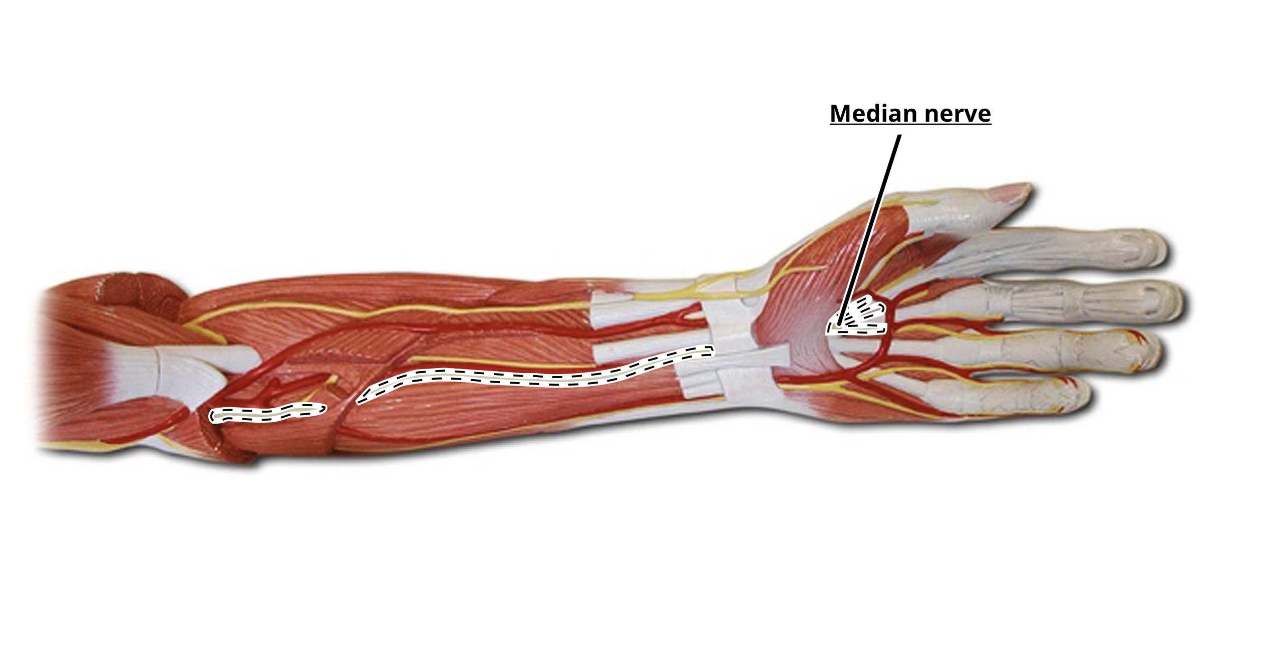 <p>Median Nerve</p>