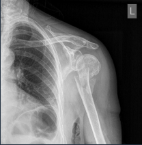 <p>According to AGE</p><ul><li><p>Children</p><ul><li><p>greenstick</p></li><li><p>buckled (impacted)</p></li><li><p>epiphyseal loosening</p></li></ul></li><li><p>Elderly: OP</p></li></ul><p>Skin status: closed / open </p>