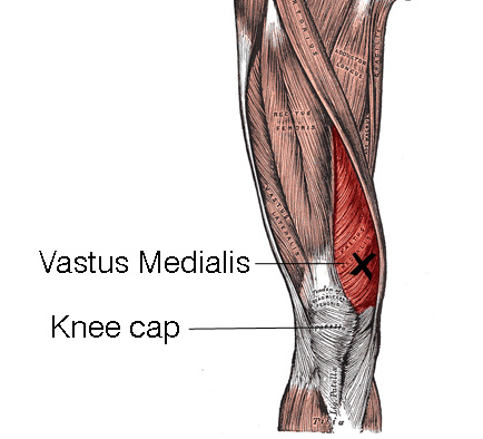 <p>vastus medialis oblique (VMO) </p>