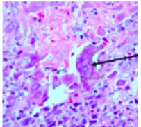 <p><span style="background-color: transparent; font-family: &quot;Times New Roman&quot;, serif;">*Cytology/biopsy needs to be done <strong>early in disease</strong> (1-3 days) – this is when we can visualize herpetic infected cells</span></p><p><span style="background-color: transparent; font-family: &quot;Times New Roman&quot;, serif;">*<strong>3 Ms: Multinucleation, molding, margination (chromatin at periphery)</strong></span></p>