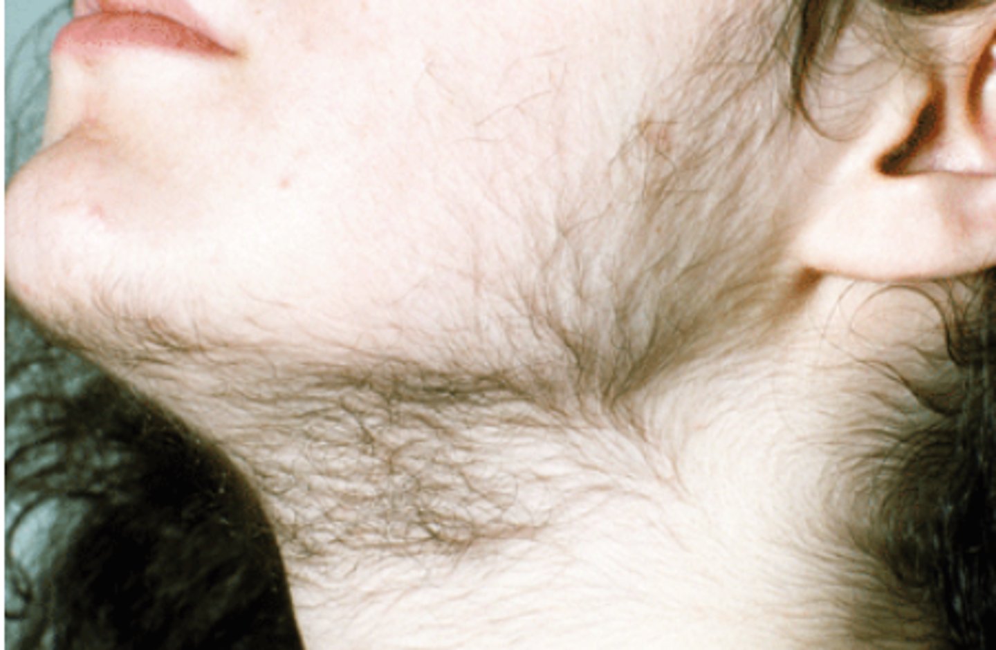 <p>-excessive hair growth</p><p>-in females with PCOS this may occur in areas where males usually grow hair: chin, face, etc.</p>