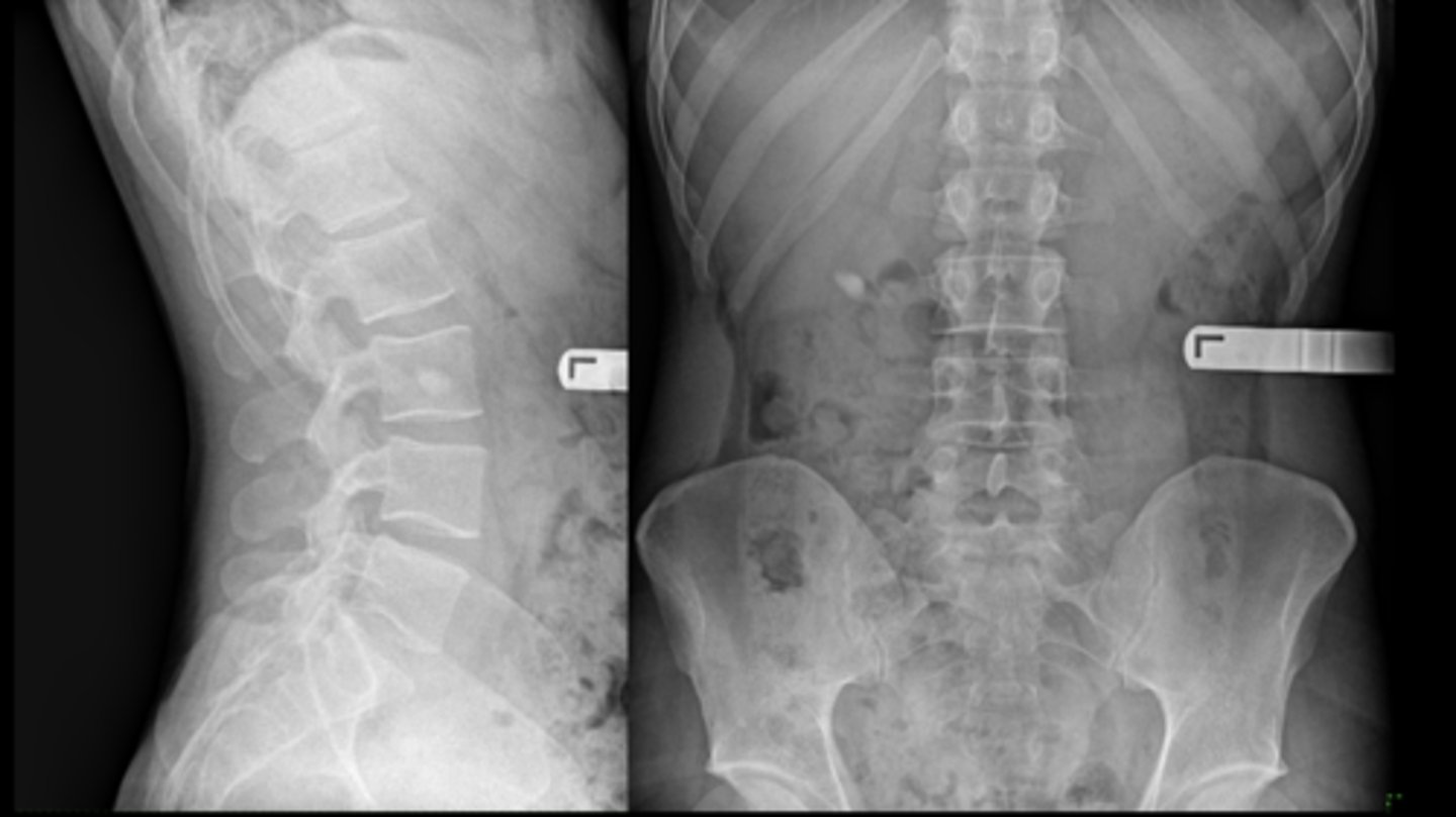<p>22 y.o. male with L/S pain, post motor vehicle accident</p><p>- Differential diagnosis?</p>