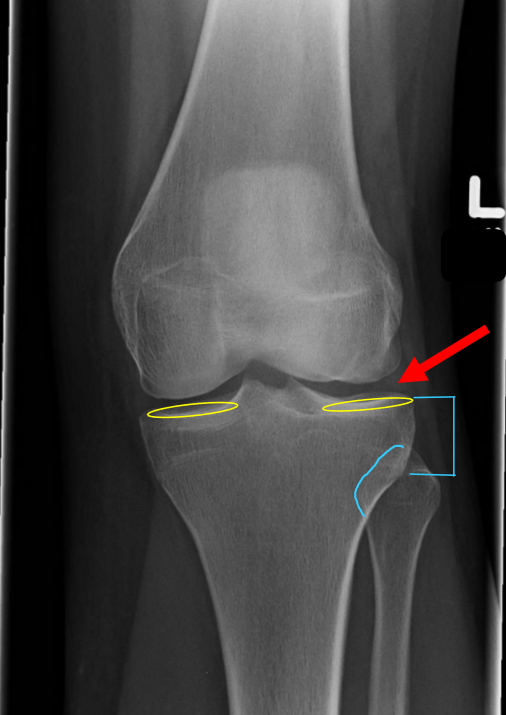 <p>MAIN:</p><ul><li><p>ant&amp;post tibial margins SI prox/dist</p></li><li><p><strong>open </strong>knee joint</p></li></ul><p>SUPPORTING:</p><ul><li><p>top of fib head midway between metaphysis and tib plateu</p></li></ul><p></p>