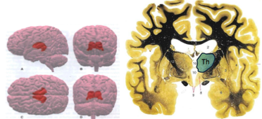 -like the "gatekeeper" of the cortex 
-all sensory information destined for the cortex must first pass through the thalamus with FEW EXCEPTIONS 
-located deep inside the brain 
-a collection of nuclei- broken down into 3 types: specific relay, association and midline/intralaminar
-one of each side of the brain and just barely touch each other at the midline 
-forms the floor of the lateral ventricle 
-the cerebral cortex also sends projections back to thalamic neurons and this tells the thalamus what inputs its receiving from sensation of the body, etc to filter out and what info to allow to be relayed to the cortex