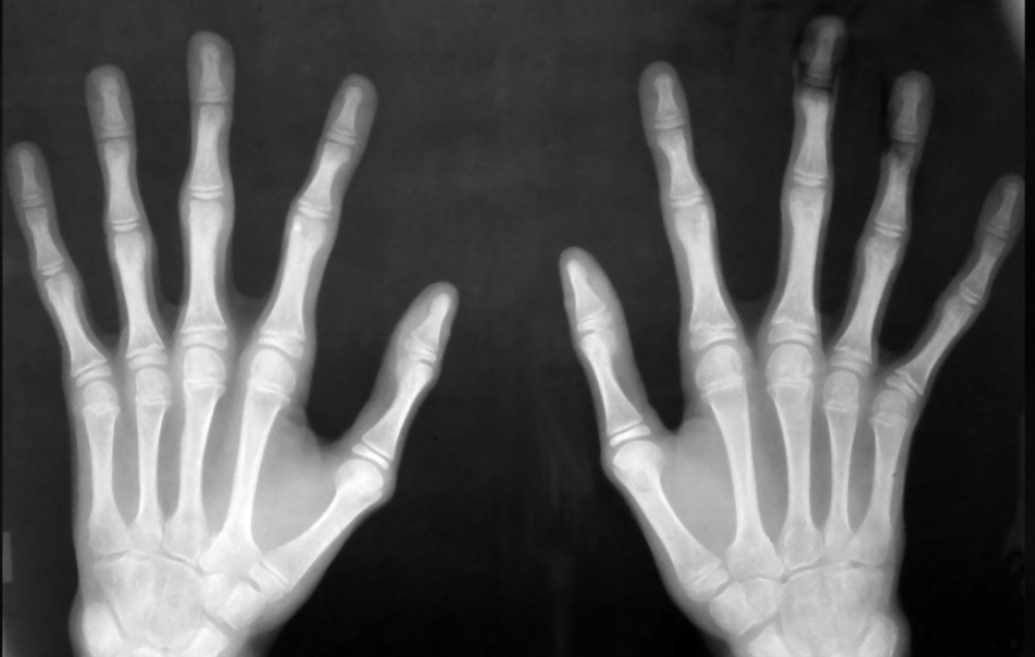 <p>what is seen here for this case of Marfan syndrome?</p>