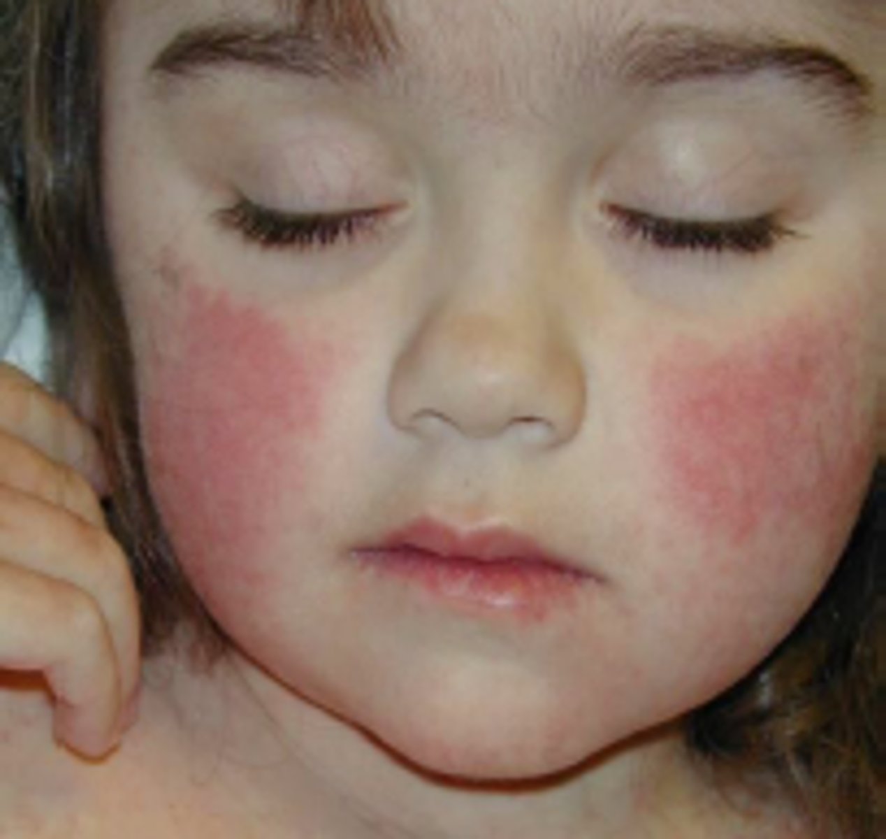 <p>"Slapped cheeks" (Erythema infectiosum/fifth disease: parvovirus B19)</p><p>Single-stranded DNA virus</p><p>Aplastic Anemia in Sickle Cell, B-thalessemia</p>