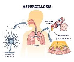 <ul><li><p>distributed worldwide</p></li><li><p>ubiquitous in air, soil, decaying matter</p><ul><li><p>A. fumigatus</p></li><li><p>A. flavus</p><ul><li><p>common in hospital environments</p></li></ul></li></ul></li><li><p>at-risk populations: “patients with”</p><ul><li><p>prolonged neutropenia</p></li><li><p>immunodeficient or immunocompromised</p></li><li><p>corticosteroids</p></li></ul></li><li><p>Aspergillosis</p><ul><li><p>route of infection: inhalation of conidia</p></li><li><p>incubation of 3 days —&gt; 3 weeks</p></li><li><p>allergic bronchopulmonary aspergillosis (ABPA): manifestations based on hypersensitivity to antigens, causes wheezing and coughing</p></li><li><p>sinusitis</p></li><li><p>invasive aspergillosis: 70% mortality! seen in neutropenic and immunodeficient patients and cystic fibrosis patients</p></li></ul></li><li><p>clinical syndromes: </p><ul><li><p>produce aflatoxin when it A. flavus contaminates food</p><ul><li><p>peanuts, dried fruits, corn, rice</p></li></ul></li><li><p>symptoms: nausea, vomiting, abdominal pain, convulsions</p></li><li><p>chronic exposure associated with liver cancer</p></li><li><p>safe levels regulated by FDA</p></li></ul></li><li><p>Diagnosis:</p><ul><li><p>aspergillus galactomannan antigen in serum</p></li><li><p>isolation from blood is rare</p></li><li><p>specimen source: bronchoalveolar valve</p></li></ul><p></p></li><li><p>Treatment:</p><ul><li><p>prevention in high risk patients</p></li><li><p>reconstitute host defenses</p></li><li><p>surgical removal</p></li><li><p>antifungal therapy — amphotericin B</p><p></p></li></ul></li></ul><p></p>