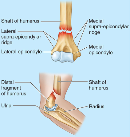 <p>Supracondylar Fracture is common in children under the age of 10, Boys>girls; MOI</p>