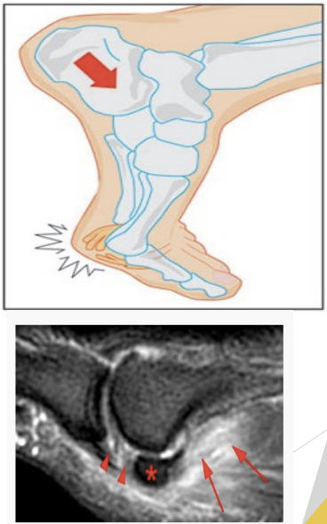 <p>Turf Toe</p>