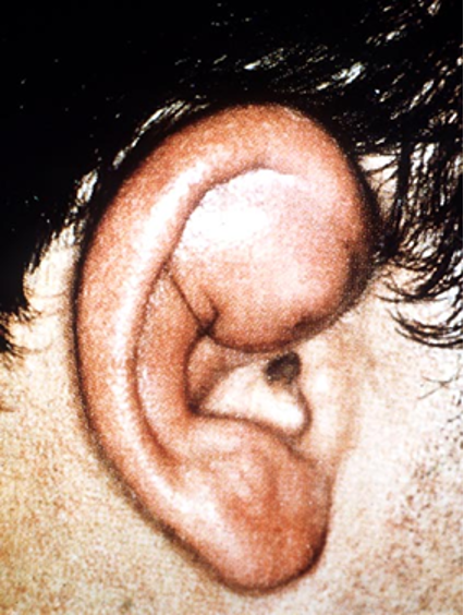 <p>fluctuant bluish swelling anterior superior auricle, blunt trauma</p>