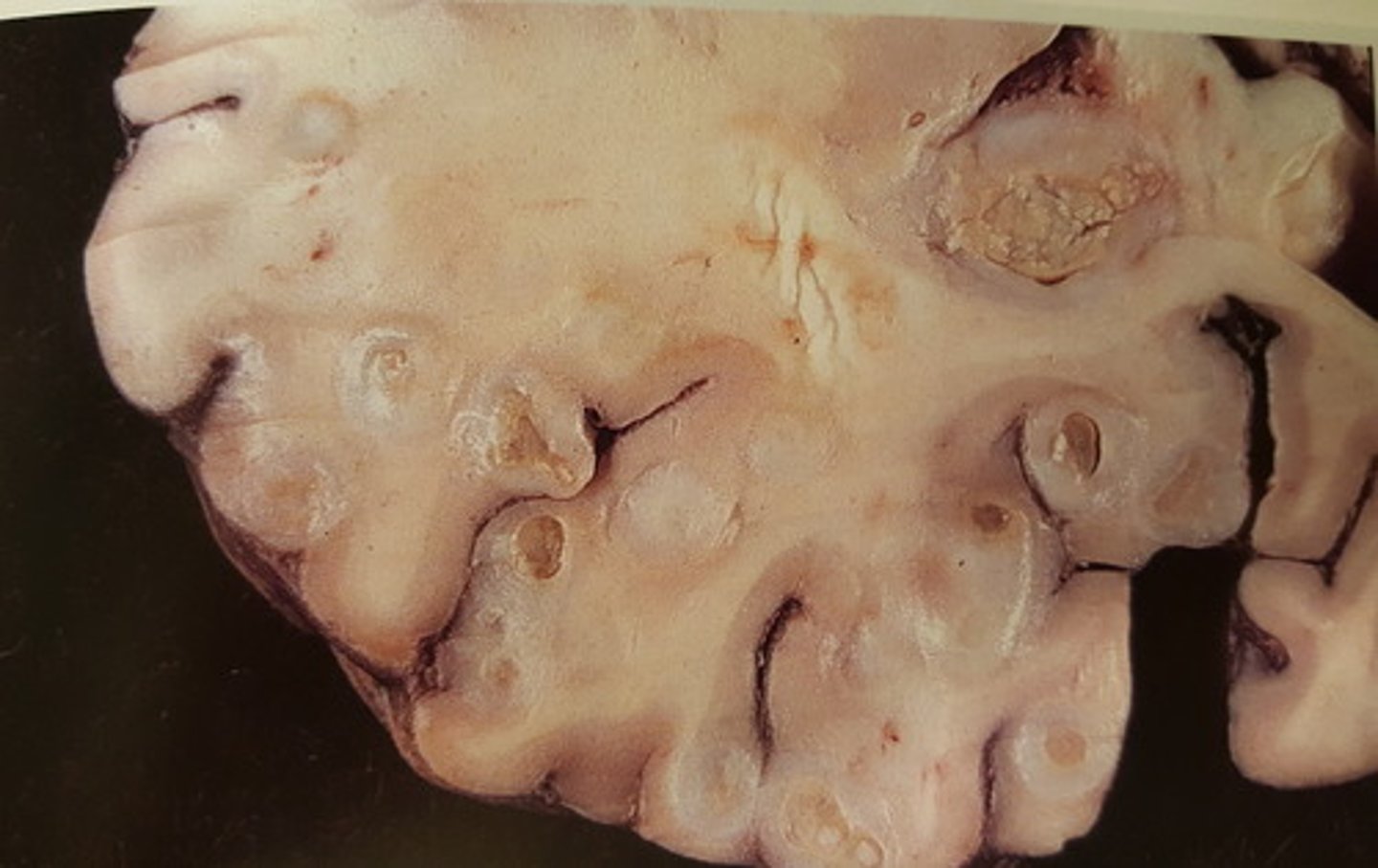 <p>Hjerne fra okse. Patoanatomisk diagnose?</p>