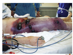 <p>causes gas gangrene</p><p>extremely serious, rapidly progressive infection</p><p>imminent risk to both limb and life</p><p>rapid destruction of muscle and severe systemic toxicity</p><p>prompt debridement of all nonviable tissue is essential</p><p>acute onset of heaviness in the area followed by severe pain, devitalization of limb, mottled skin, fluid or gas-filled blisters on the skin</p>