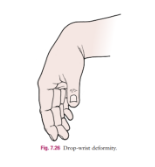 <p><span><strong>Drop wrist/Radial nerve palsy</strong></span></p><p><span><strong>“Kobe deformity” - S’Charles (Bro wtf T_T)</strong></span></p>