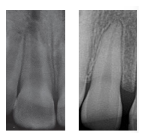 <p><strong><u>Immature:</u></strong></p><ul><li><p><strong>Shorter roots </strong>(tooth cannot withstand a lot of force, stage 1 and 2 may not be suitable for any pulp therapy)</p></li><li><p>Wide open apex (allows more blood to enter roots - better healing, also nothing stopping extrusion of material)</p></li><li><p>Thin dentine walls&nbsp;(affects the prognosis of tooth, trauma may fracture the tooth in the future when treating immature teeth)</p></li></ul><p><strong><u>Mature:</u></strong></p><ul><li><p>Closed apex</p></li><li><p>Long root</p></li><li><p>Thin dentine walls&nbsp;</p></li></ul><p></p>