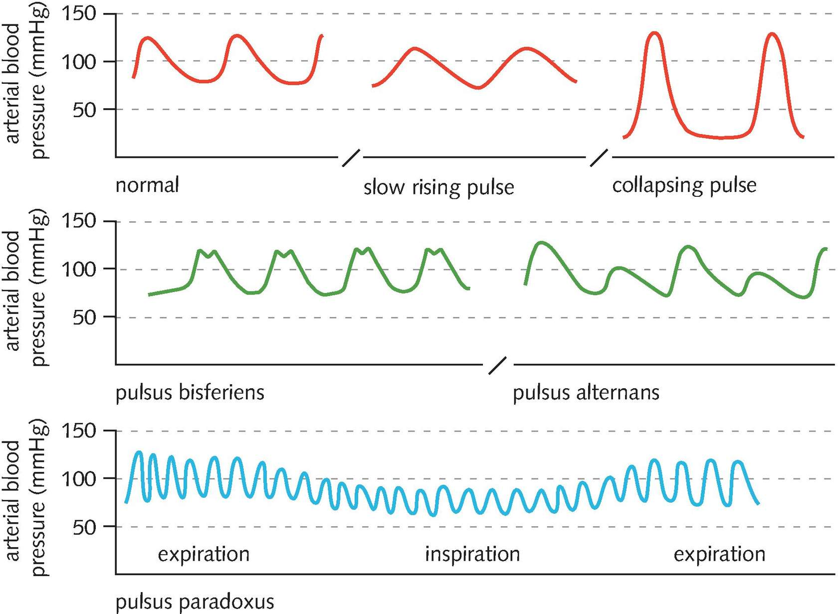<p>Collapsing pulse&nbsp;</p><p>Bifid pulse (pulsus bisferiens)</p><p>Plateau pulse</p><p>Pulsus alternans</p>