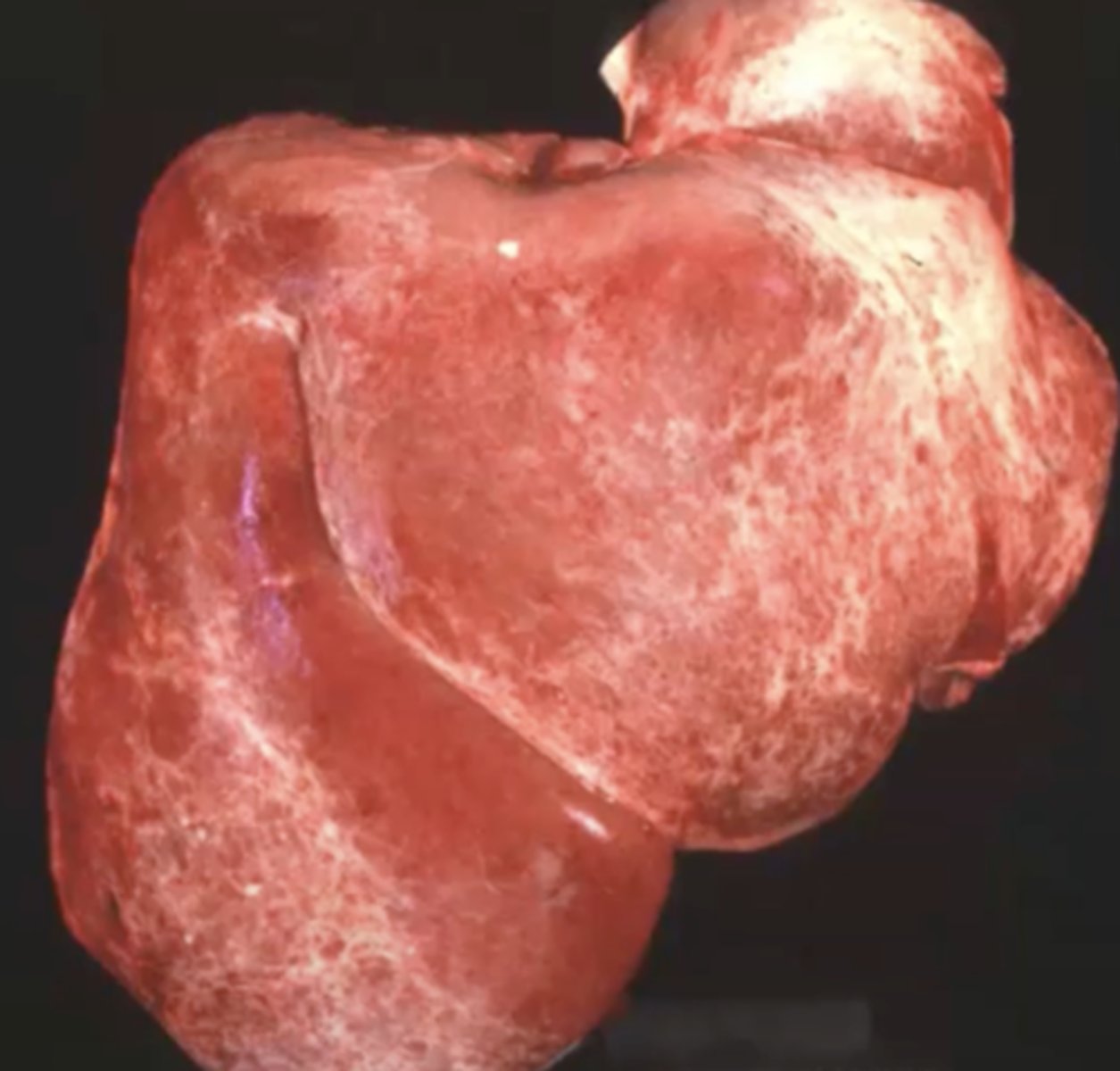 <p>What has caused this gross appearance of this liver?</p>