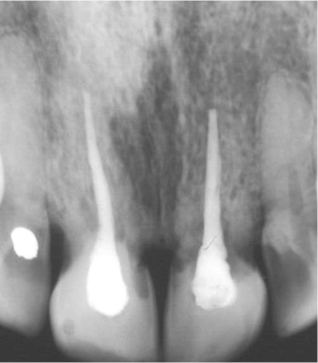 <p>•Severe damage to the periodontium (Intrusion, Avulsion)</p><p>•“Fusion” of the tooth root with the adjacent alveolar bone</p><p>•Diagnosis:</p><p>-Tooth is immobile</p><p>-High percussive tone</p><p>-No visible PDL space</p><p>•Treatment:</p><p>-Cannot be arrested or repaired</p><p>•Survive for a number of years</p>