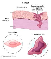 <p>Cancer</p>