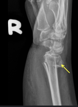 <p>extension fracture of radius (displaced posteriorly)</p>