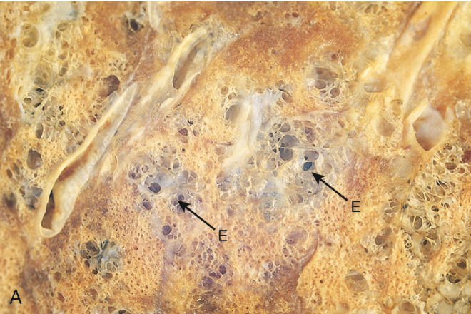 <p>Tipo de enfisema</p>